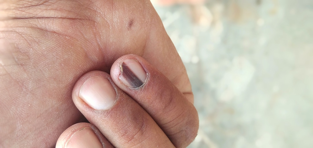 What Does Skin Cancer Under Fingernail Look Like