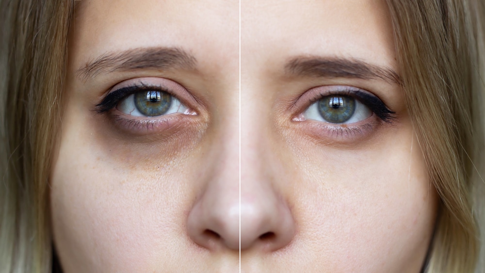 A side-by-side close-up of a woman with and without dark circles under her eyes.