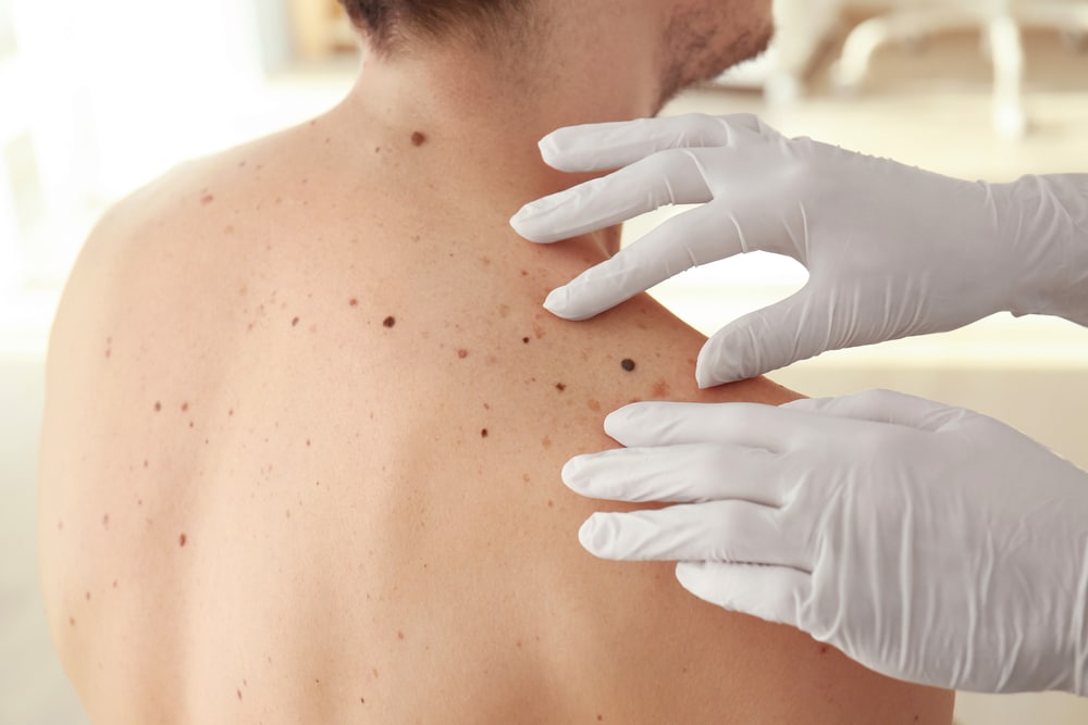 Skin Cancer Awareness: 5 Ways to Reduce Your Risk of Skin Cancer