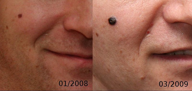 Moles can change quickly, so skin checks are so important