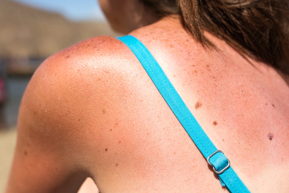 Sunburns and Skin Cancer: How Are They Related?