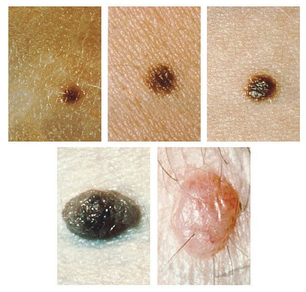 It's important to know how moles can present on your skin