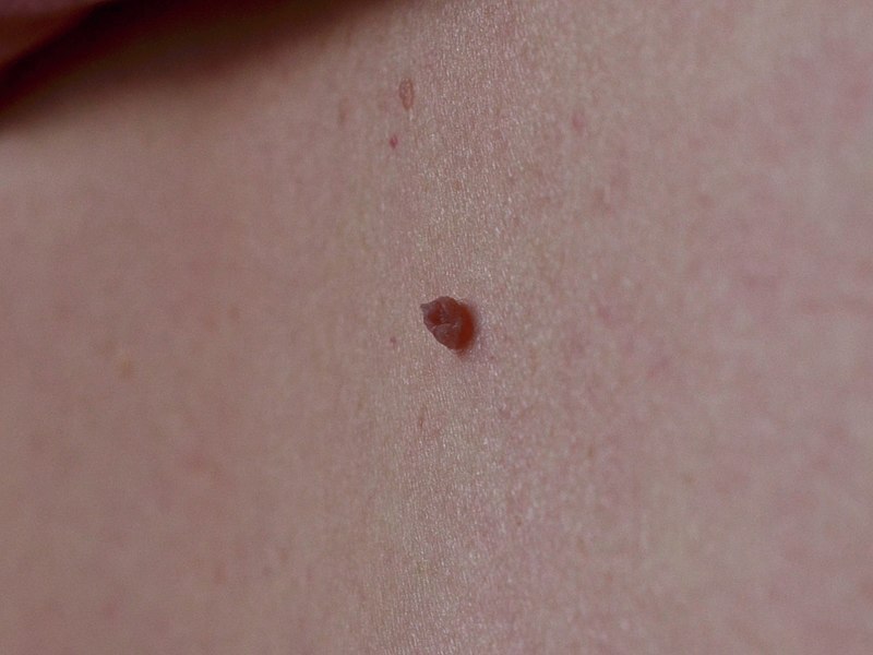 Skin tags are connected to your skin by a stalk