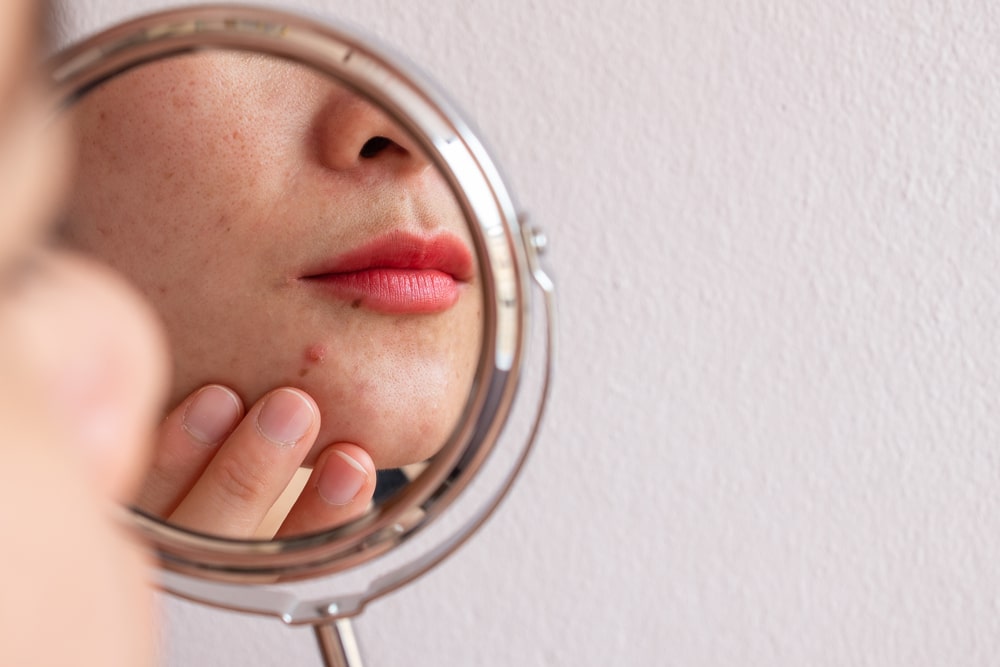 Tips from a Derm: How to Prevent Acne