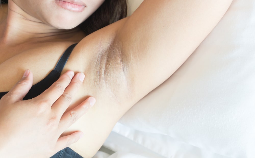 How to Get Rid of Dark Armpits