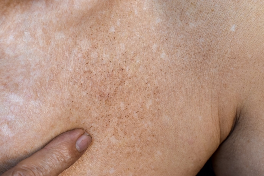 Age spots and white patches on chest of Asian elder man. Age soots are brown, gray, or black spots and also called liver spots, or sun spots.