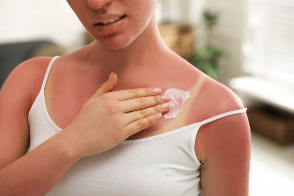 Woman applying cream on sunburn at home, closeup