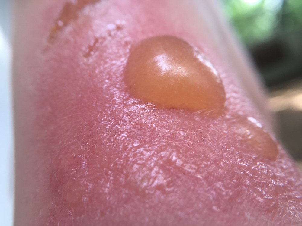 Second-degree sunburn on the skin of a child in the blisters￼