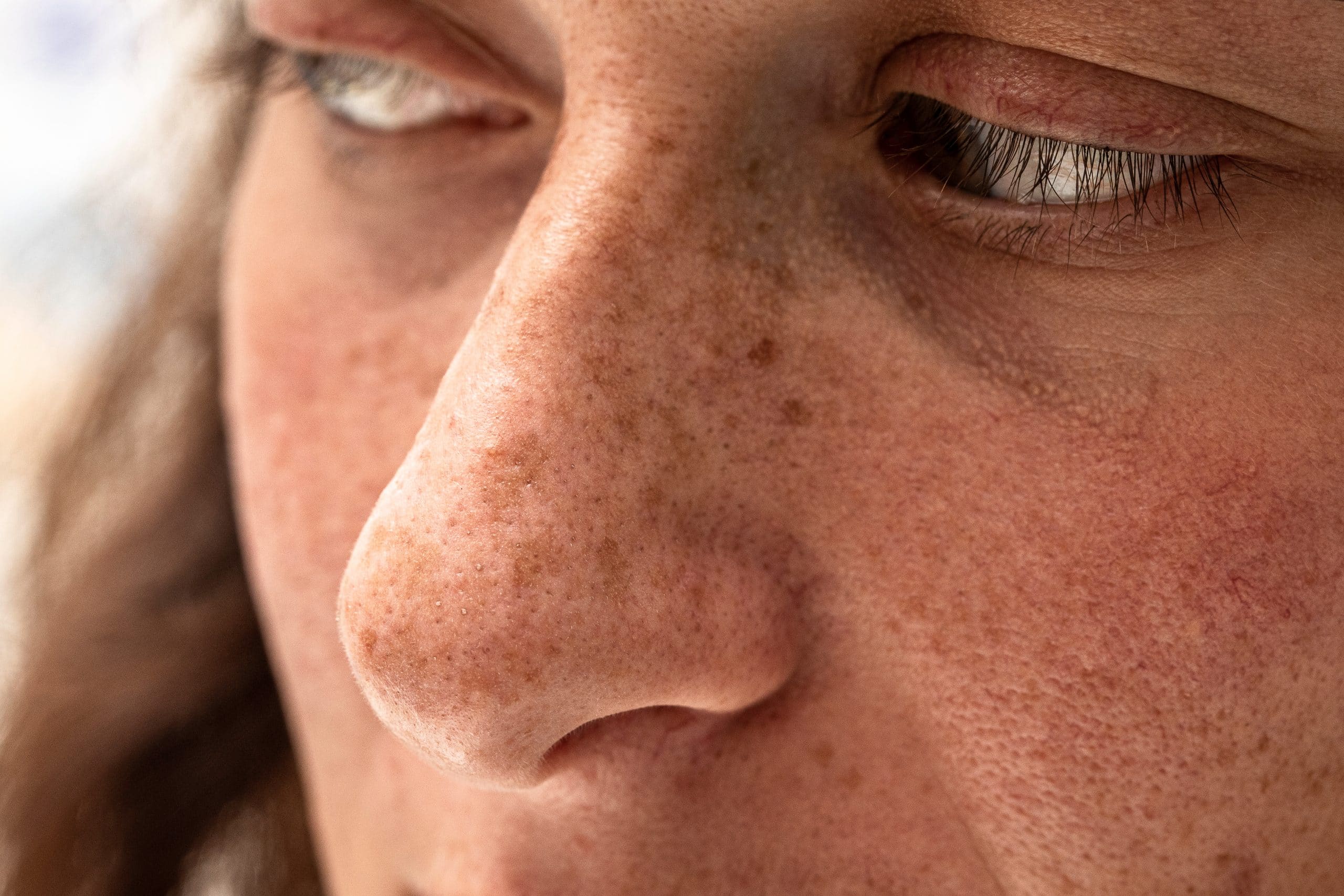 A freckled nose with sunlight resting on it.