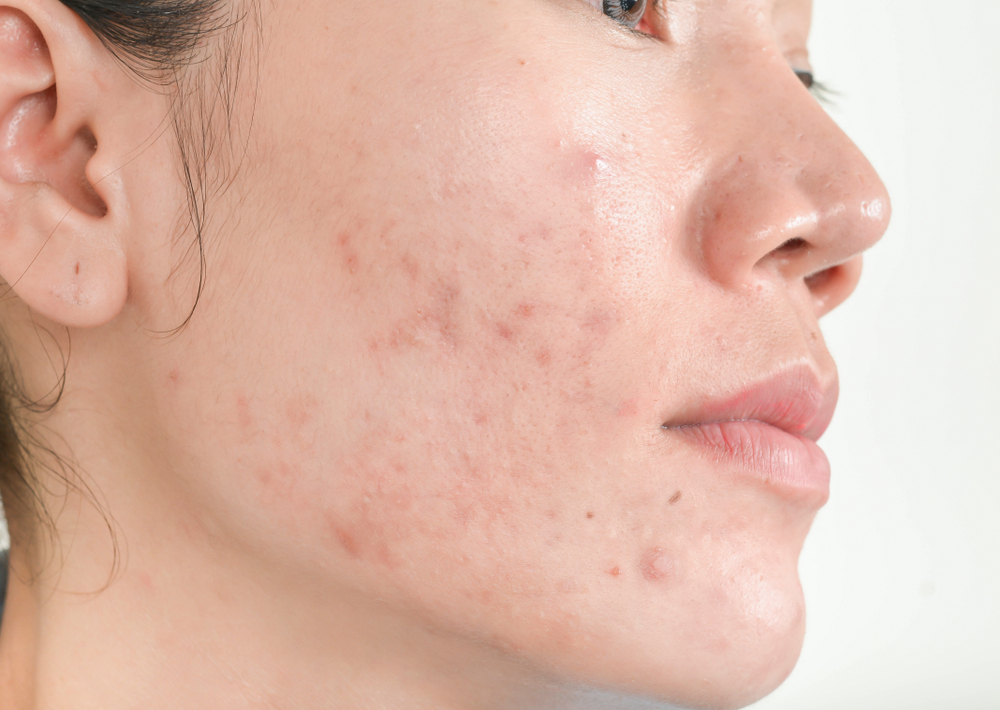 Scar from Acne on face . and dark spots and skin problems and make-up in women