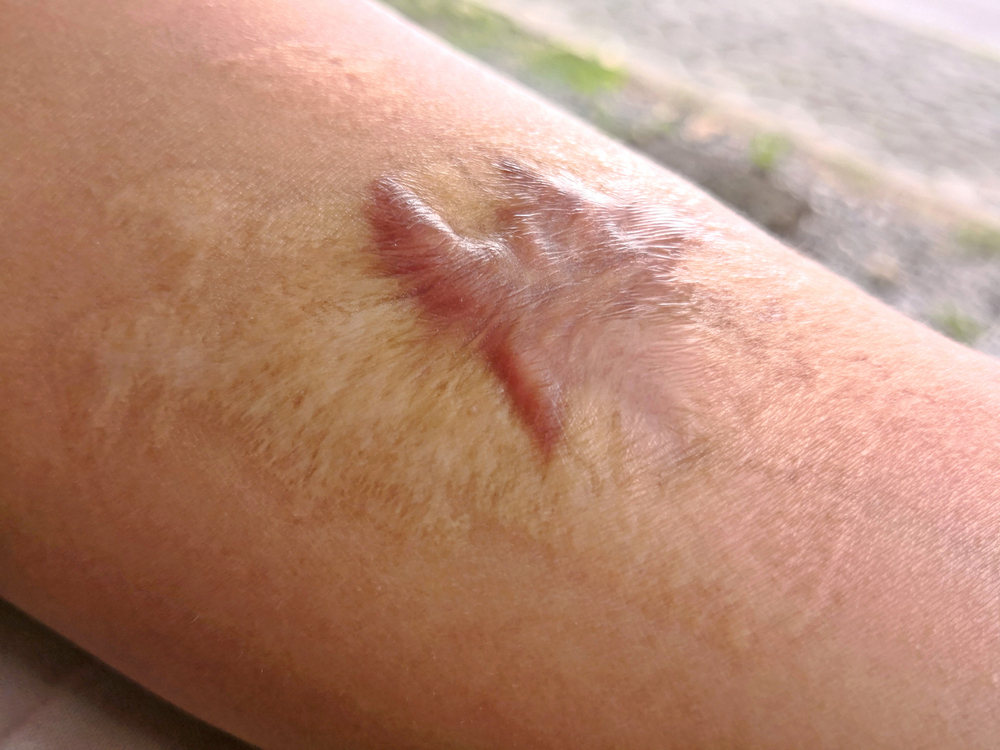 Close up Keloid scar (Hypertrophic Scar) on man arm skin after accident.
