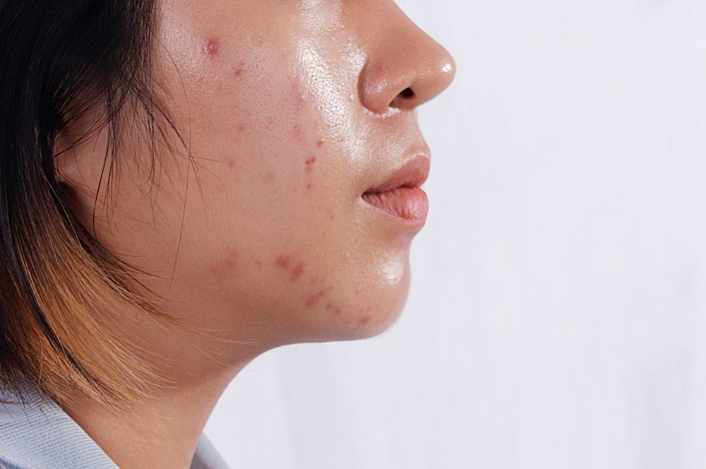 Close up Acne skin caused by Hormone,Oily face in woman face. Right side