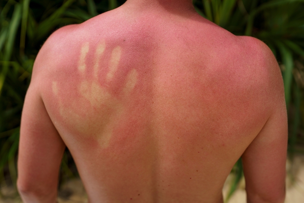 sunburn-and-skin-cancer-how-are-they-related